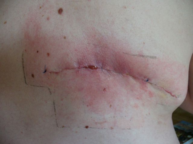pæne ar efter operation pæne ar efter operation