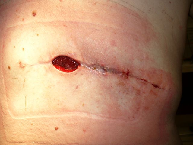 sår efter operation sår efter operation